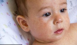 小孩吃角瓜过敏,警惕常见蔬菜背后的健康隐患