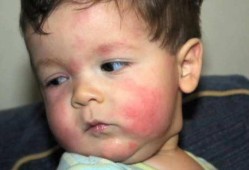 小孩吃角瓜过敏,警惕常见蔬菜背后的健康隐患