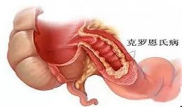 克罗恩病可不可以吃白瓜,白瓜的适宜性探讨