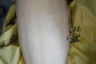 克罗恩病可不可以吃白瓜,白瓜的适宜性探讨